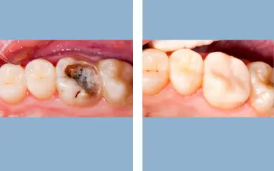 Before and After